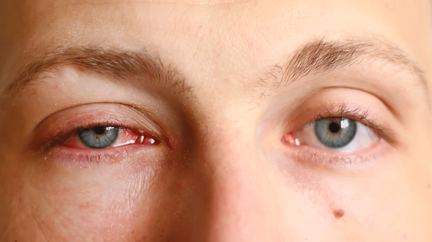 Why Are My Eyes Crusty In The Morning | Health Tips Now