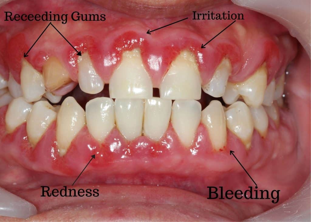 The Consequences Of Neglecting Dental Health