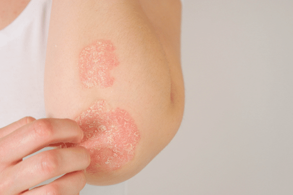 Causes Of Getting A Rash And How To Treat It