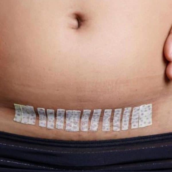 Everything You Need To Know About C-Section Scars