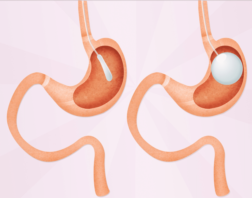 Everything You Need To Know About Gastric Balloons